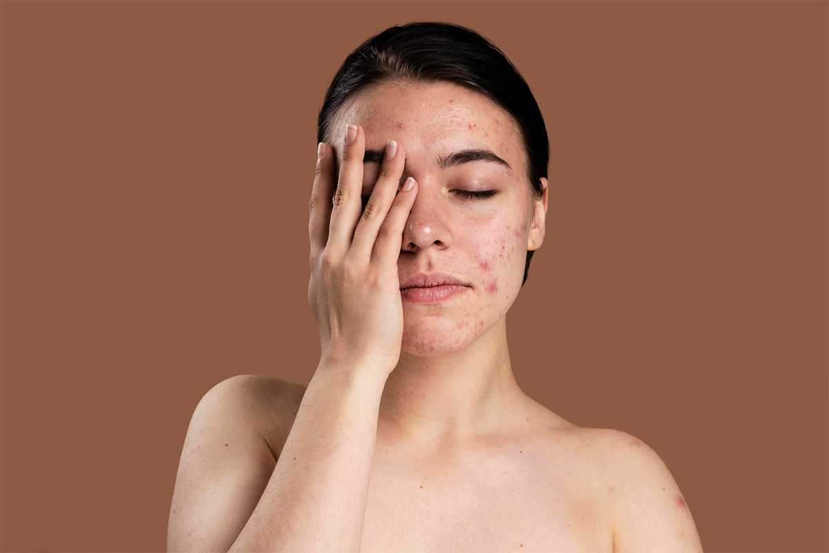 Remedios caseros remedios caseros efectivos para el acne consejos naturales 1
